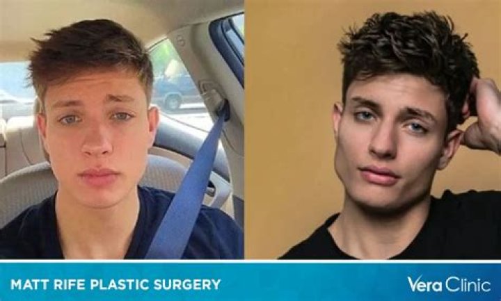 Before and After Matt Rife Plastic surgery: Just rumors or truth?