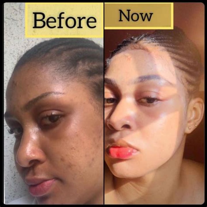 Bleach Skin Before And After: A Comprehensive Guide