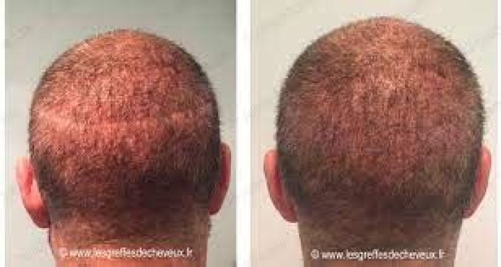 Dermopigmentation Capillaire Prix
