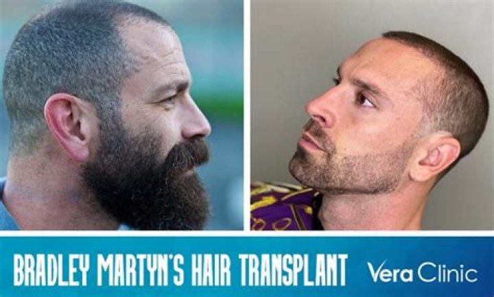 Did Bradley Martyn Get A Hair Transplant? Before And After