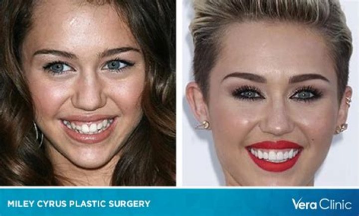 Did Miley Cyrus Get Plastic Surgery