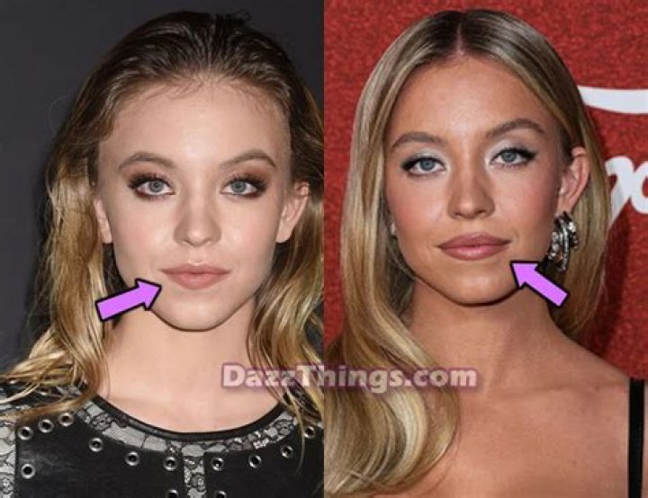 Did Sydney Sweeney Undergo Plastic Surgery? Truth Behind The Rumors