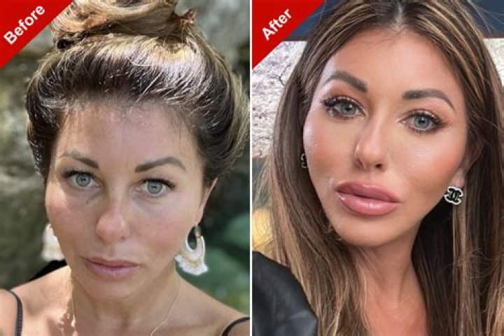 	DILLER FACES UP TO PLASTIC SURGERY	