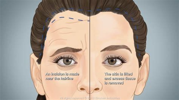 Exploring The Lives Of Actresses With Scars Between Their Eyebrows