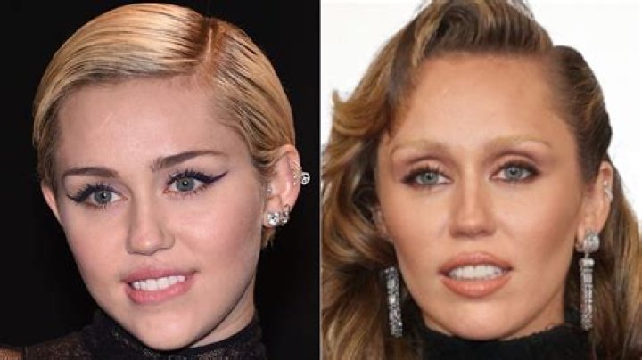Fans Are Convinced That Miley Cyrus Receives Botox