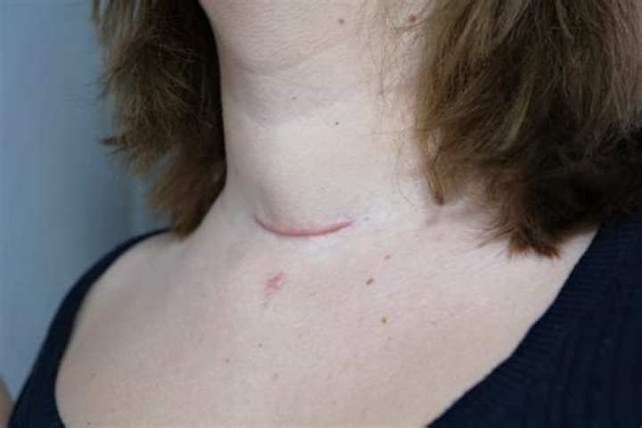 	Fatigue set in after thyroid surgery	