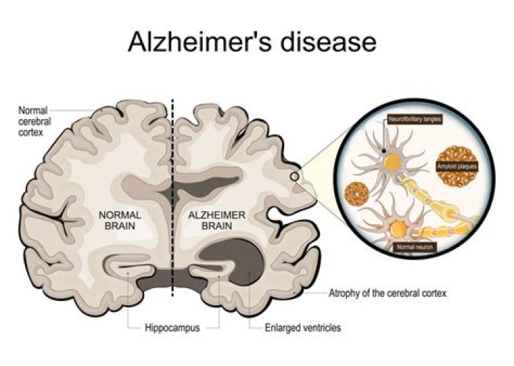 How does dementia affect sleep?