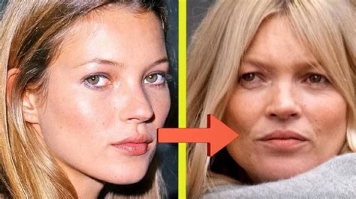 Kate Moss Chirurgie