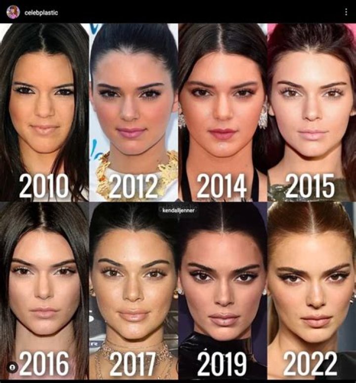 Kendall Jenner Before And After Plastic Surgery