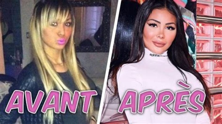 Maeva Avant Chirurgie