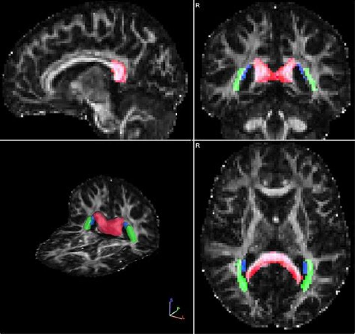 Noticing the signs and stages of Posterior Cortical Atrophy (PCA)