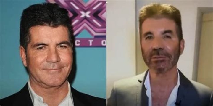 Simon Cowell Chirurgie
