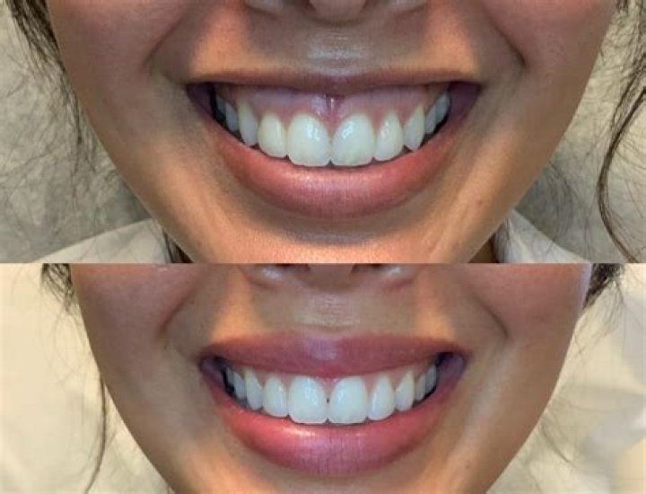 Transform Your Smile: The Journey Of Lip Plumper Before And After