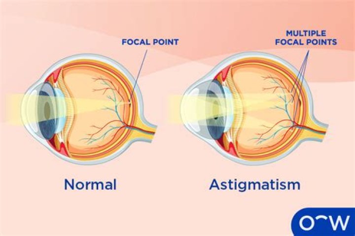 Uncover The Secrets Of Astigmatism Through Revealing Images