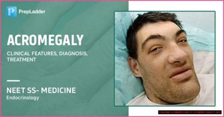 Understanding Matthew McGrory's Disease: A Comprehensive Guide