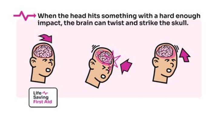 Unveiling The Critical Reasons: Why Hitting The Back Of The Head Is Illegal