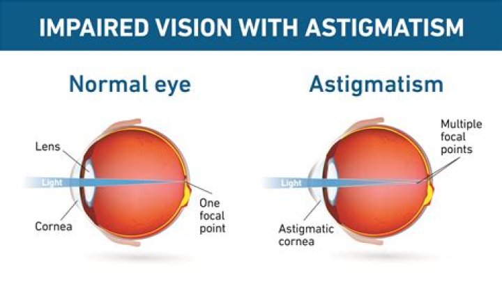 Unveiling The Enigma Of Stigmatism: Discoveries And Insights