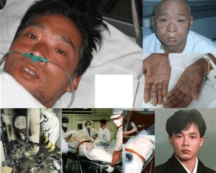 Unveiling The Tragedy: Hisashi Ouchi Photos After Radiation